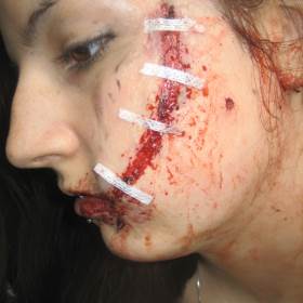 Laceration, Multiple Screwdriver Wounds